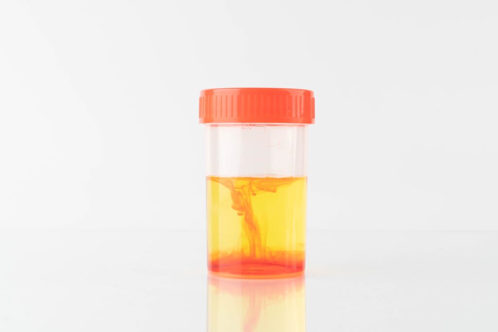 Blood in urine (hematuria) sample bottle in laboratory.